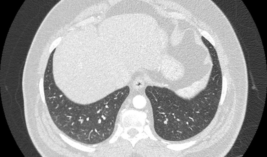 Acute pulmonary embolism with pulmonary infarcts (Radiopaedia 77688-89908 Axial lung window 107).jpg