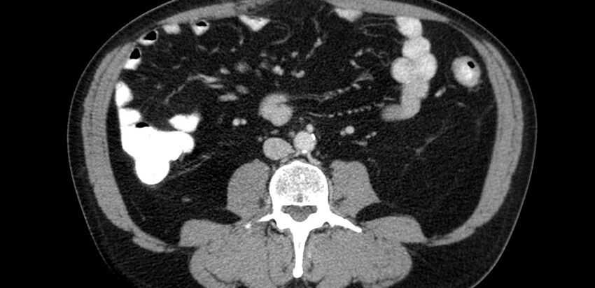 Acute sigmoid colon diverticulitis (Radiopaedia 55507-61976 Axial C+ portal venous phase 28).jpg