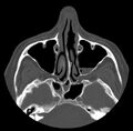 Acute sinusitis (Radiopaedia 23161-23215 Axial bone window 29).jpg