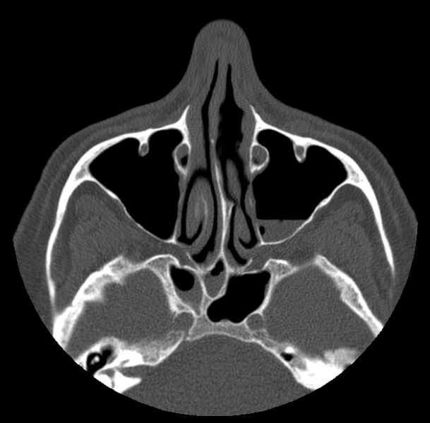 File:Acute sinusitis (Radiopaedia 23161-23215 Axial bone window 29).jpg