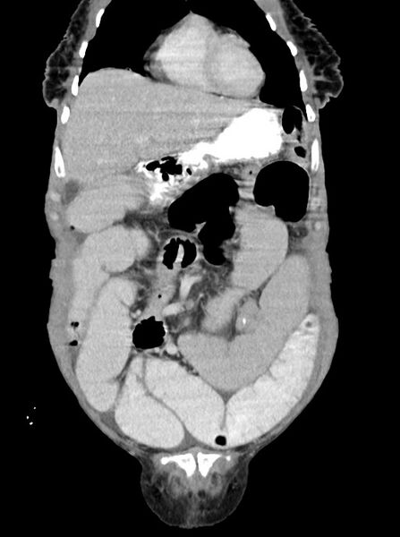 File:Acute small bowel (ileal) volvulus (Radiopaedia 71740-82139 Coronal C+ portal venous phase 30).jpg