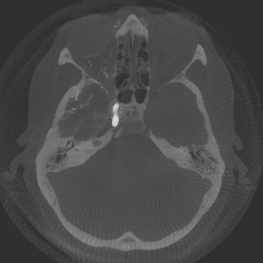 Acute subarachnoid hemorrhage and accessory anterior cerebral artery (Radiopaedia 69231-79010 Axial arterial - MIP 20).jpg