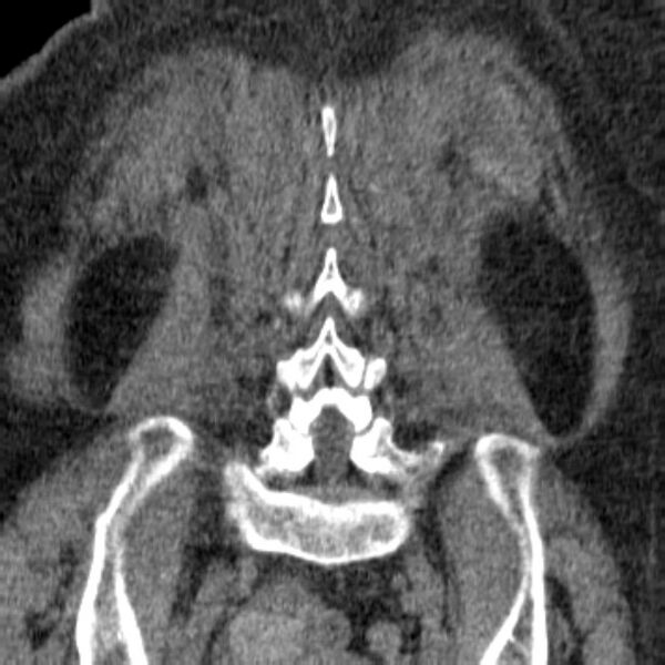 File:Acute tubular necrosis (Radiopaedia 28077-28334 Coronal non-contrast 34).jpg