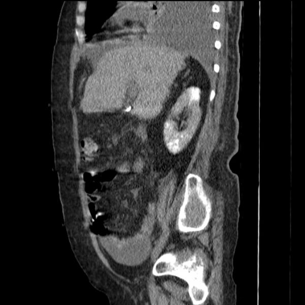 File:Acute tubular necrosis (Radiopaedia 28077-28334 Sagittal non-contrast 33).jpg