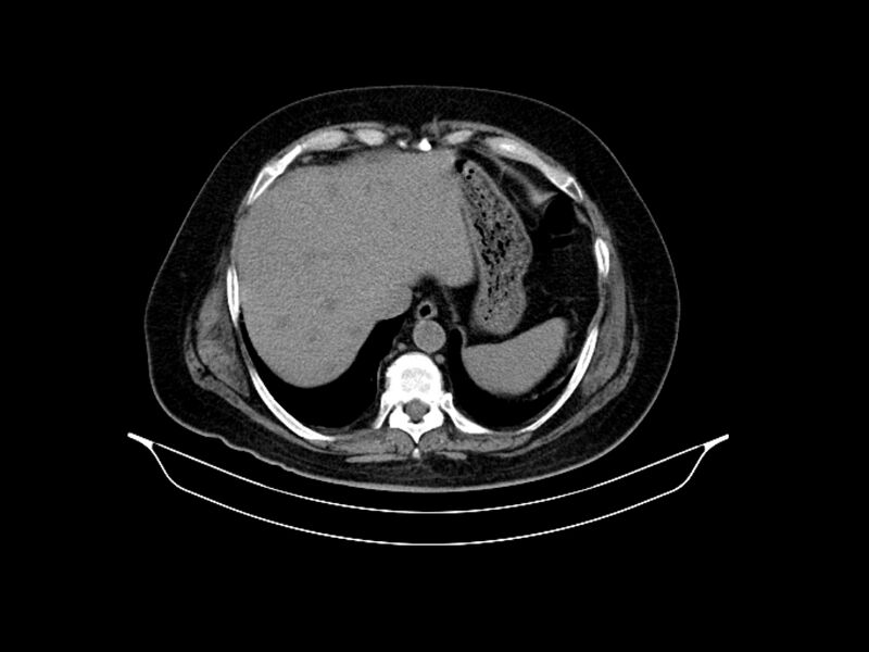 File:Adenocarcinoma of pancreas with hepatic metastasis (Radiopaedia 64332-73122 Axial non-contrast 19).jpg