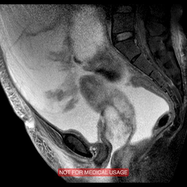 File:Adenocarcinoma of the cervix (Radiopaedia 28373-28615 Sagittal T2 fat sat 8).jpg