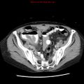 Adenocarcinoma of the colon (Radiopaedia 8191-9039 Axial renal excretory phase 45).jpg