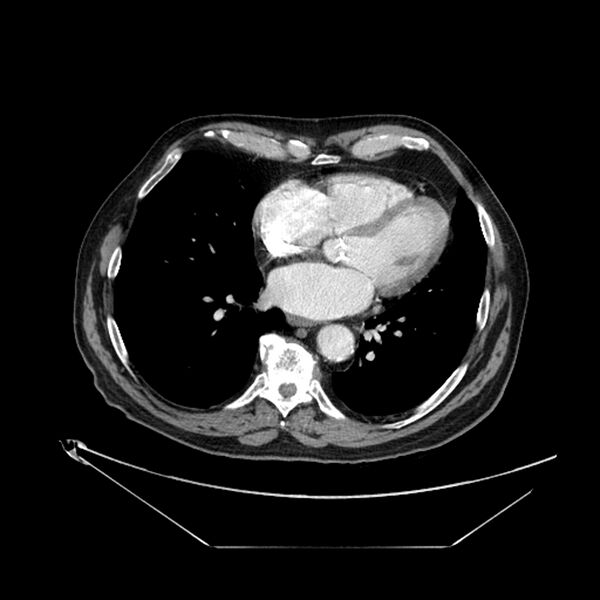 File:Adenocarcinoma of the lung (Radiopaedia 44876-48759 Axial C+ portal venous phase 54).jpg