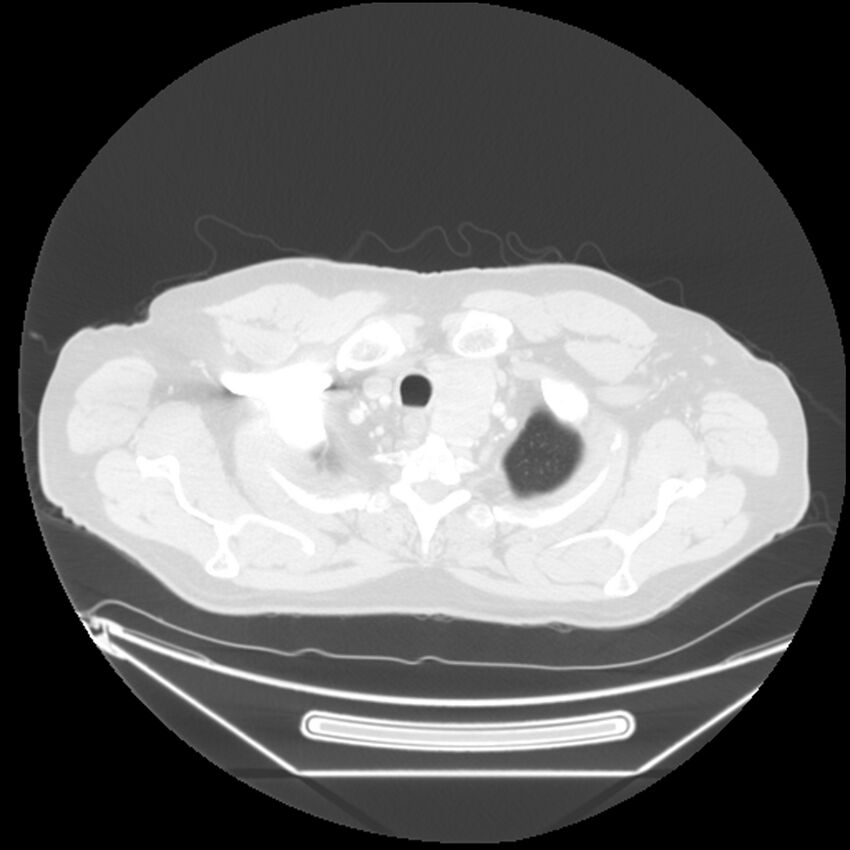 Adenocarcinoma of the lung (Radiopaedia 44876-48759 Axial lung window 3).jpg