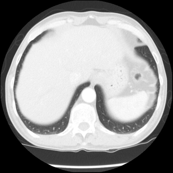 File:Adenocarcinoma of the lung - micropapillary predominant (Radiopaedia 42446-45563 Axial lung window 64).jpg