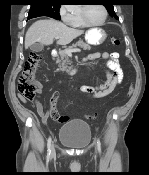 File:Adenocarcioma of rectum- T1 lesion (Radiopaedia 36921-38547 Coronal C+ portal venous phase 26).png