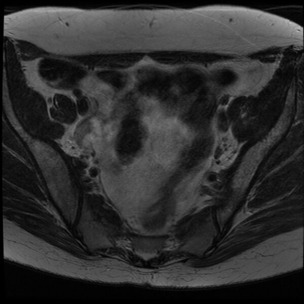 File:Adenoma malignum of the cervix (Radiopaedia 24460-24765 C 2).jpg
