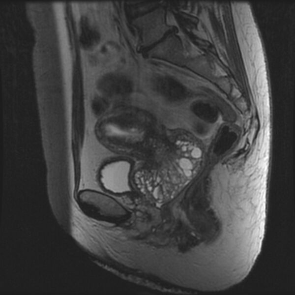 File:Adenoma malignum of the cervix (Radiopaedia 24460-24765 T2 44).jpg