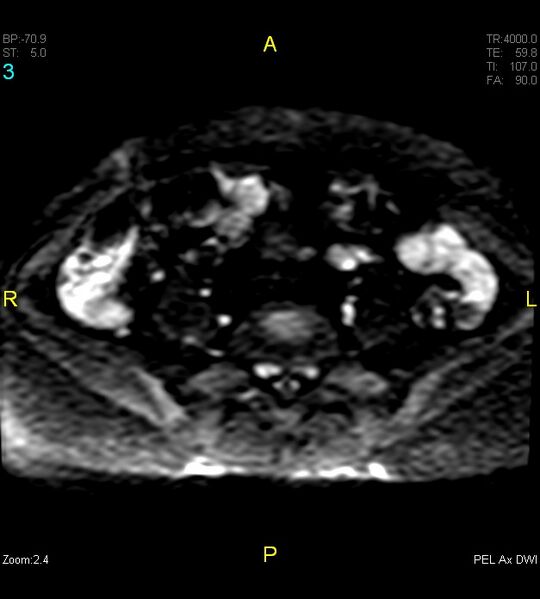 File:Adenomyosis (Radiopaedia 43504-46889 Axial DWI 3).jpg