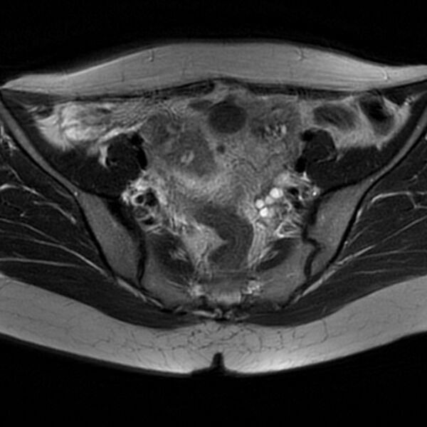 File:Adenomyosis within a septate uterus (Radiopaedia 69963-79981 Axial T2 15).jpg