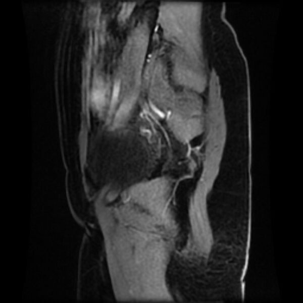 File:Adenomyosis within a septate uterus (Radiopaedia 69963-79981 Sagittal LAVA-Dyn 28).jpg