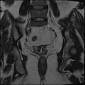 Adnexal multilocular cyst (O-RADS US 3- O-RADS MRI 3) (Radiopaedia 87426-103754 Coronal T2 21).jpg