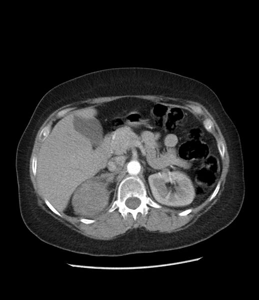 File:Adrenal cortical carcinoma with IVC invasion and thrombosis (Radiopaedia 34307-35597 Axial C+ arterial phase 29).jpg