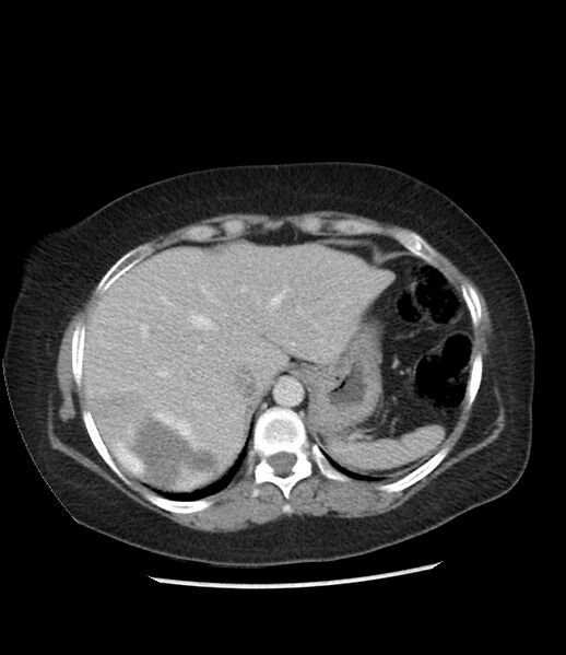 File:Adrenal cortical carcinoma with IVC invasion and thrombosis (Radiopaedia 34307-35597 Axial C+ portal venous phase 15).jpg