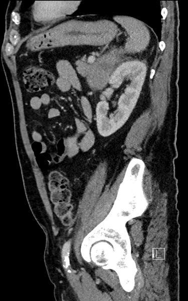 File:Adrenal lymphoma (Radiopaedia 73730-84529 Sagittal C+ portal venous phase 80).jpg