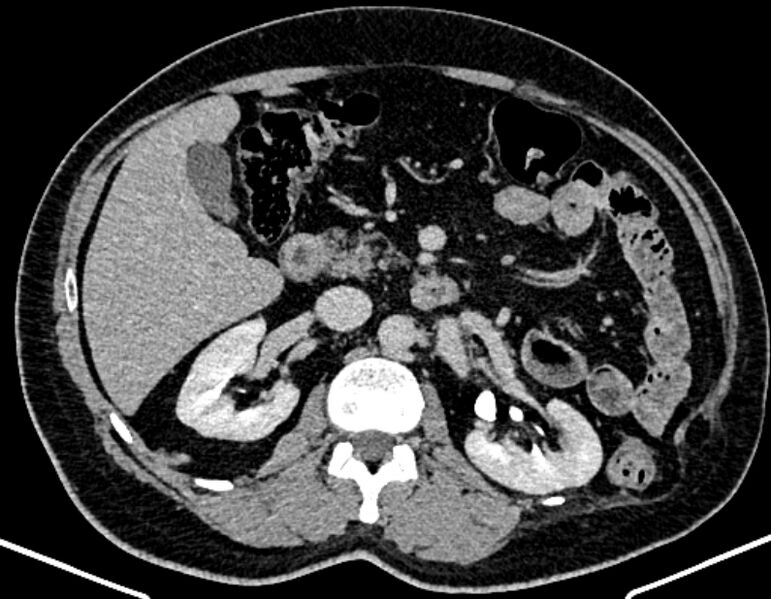 File:Adrenal metastases (Radiopaedia 73082-83791 Axial C+ delayed 134).jpg