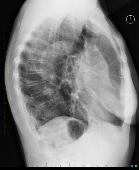 File:Adrenal metastasis from small cell lung cancer (Radiopaedia 19133-19107 Lateral 1).jpg