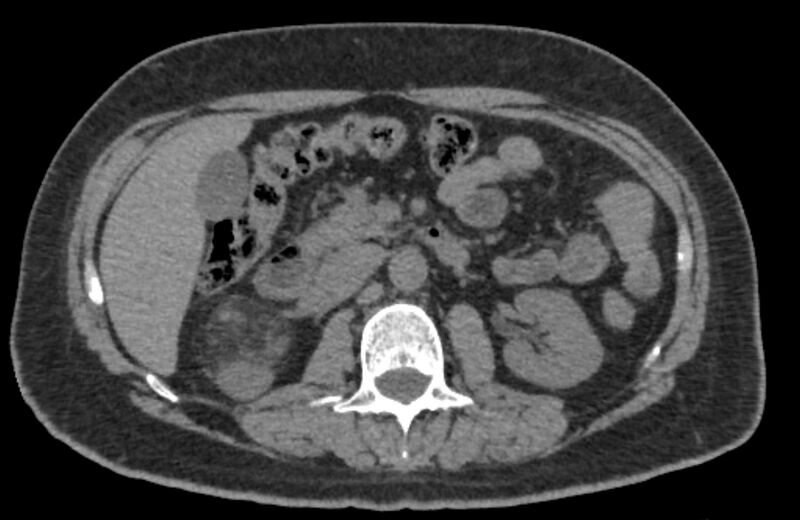 File:Adrenal myelolipoma (Radiopaedia 65240-74253 Axial non-contrast 58).jpg