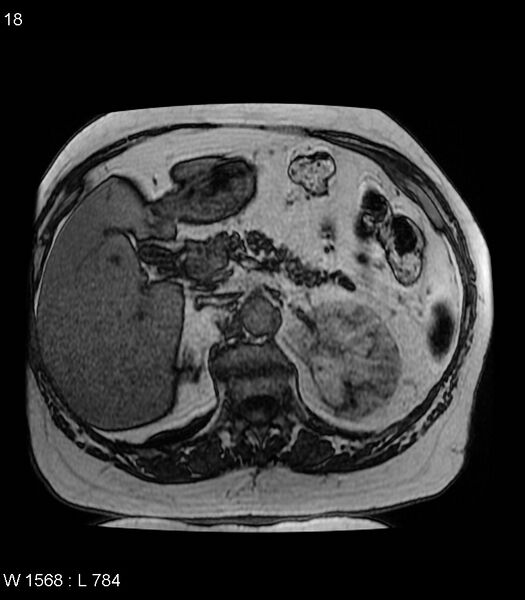 File:Adrenal myelolipoma (Radiopaedia 6765-7961 Axial T1 out-of-phase 18).jpg