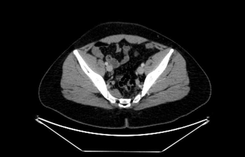 File:Adrenocortical carcinoma (Radiopaedia 80134-93438 Axial C+ portal venous phase 109).jpg
