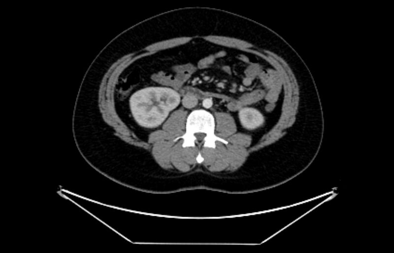 File:Adrenocortical carcinoma (Radiopaedia 80134-93438 Axial C+ portal venous phase 66).jpg