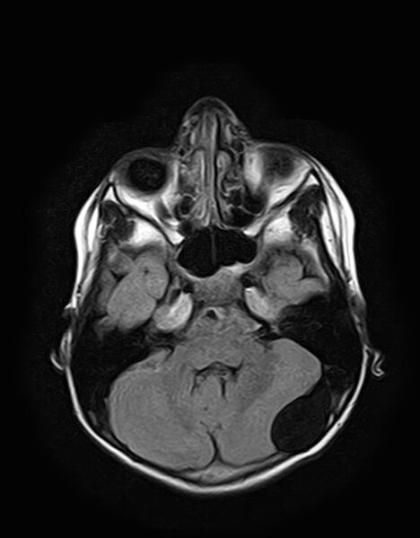 File:Aicardi syndrome (Radiopaedia 66029-75205 Axial FLAIR 7).jpg