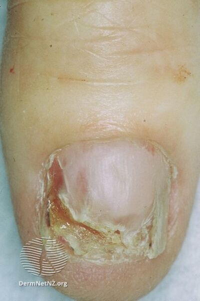 File:Amelanotic melanoma of nail unit (DermNet NZ doctors-dermoscopy-course-images-amelanotic-melanoma1).jpg