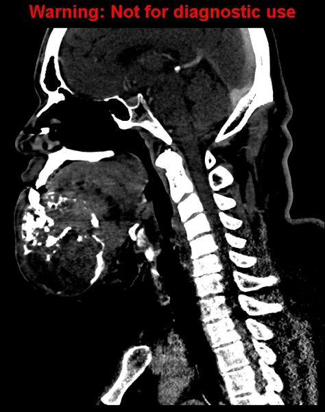 File:Ameloblastoma (Radiopaedia 33126-34164 F 37).jpg