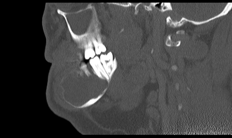 File:Ameloblastoma (Radiopaedia 33677-34806 Sagittal bone window 23).png