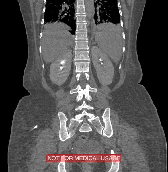 File:Amoebic enterocolitis with liver abscess (Radiopaedia 35100-36609 B 152).jpg
