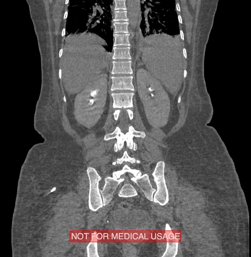 Amoebic enterocolitis with liver abscess (Radiopaedia 35100-36609 B 152).jpg