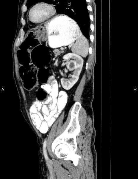 File:Ampullary adenocarcinoma (Radiopaedia 86093-102032 D 73).jpg