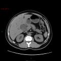 Ampullary carcinoma (Radiopaedia 56396-63056 Axial non-contrast 18).jpg