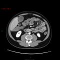 Ampullary carcinoma (Radiopaedia 56396-63056 B 42).jpg