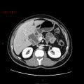 Ampullary carcinoma (Radiopaedia 56396-63056 C 35).jpg