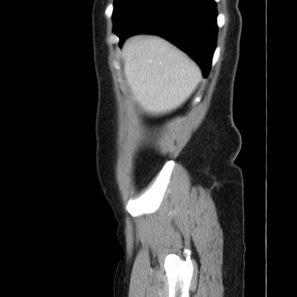 File:Ampullary tumor (Radiopaedia 22787-22816 D 8).jpg