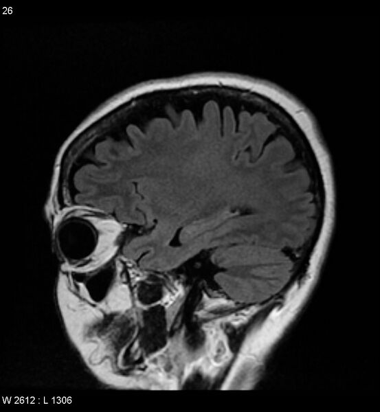 File:Amyotrophic lateral sclerosis (Radiopaedia 5373-7134 Sagittal FLAIR 22).jpg