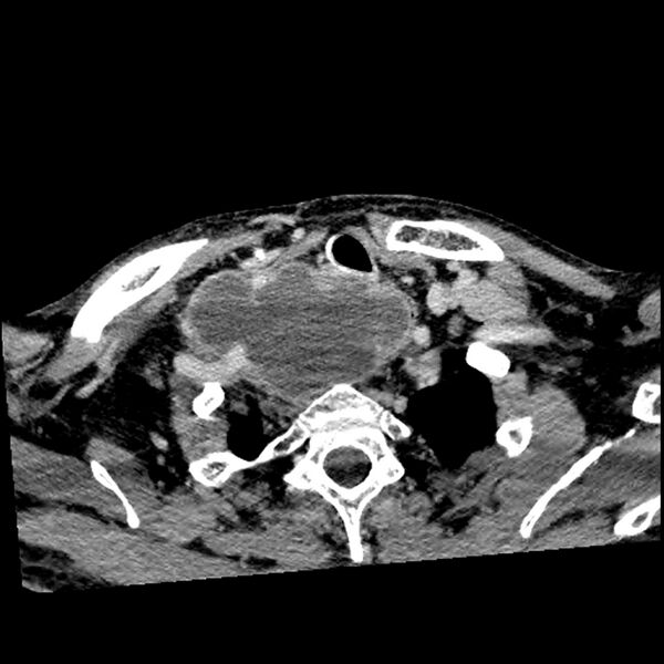 File:Anaplastic thyroid carcinoma (Radiopaedia 79087-92034 B 33).jpg