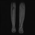 Aneurysmal bone cyst - tibia (Radiopaedia 22343-22367 Coronal STIR 16).jpg
