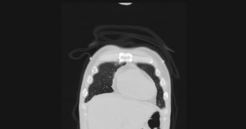 File:Angioinvasive aspergellosis (Radiopaedia 66995-76315 Coronal lung window 5).jpg