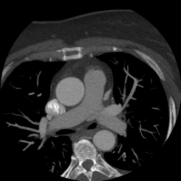 File:Anomalous origin of left circumflex artery from right coronary sinus (Radiopaedia 72563-83117 A 52).jpg