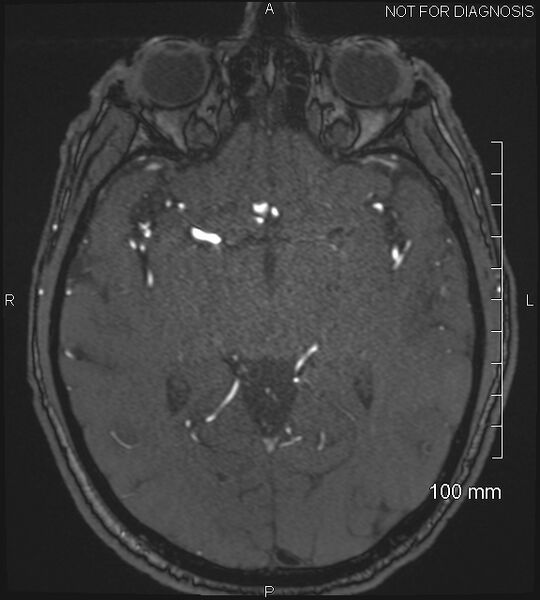 File:Anterior cerebral artery aneurysm (Radiopaedia 80683-94127 Axial MRA 110).jpg