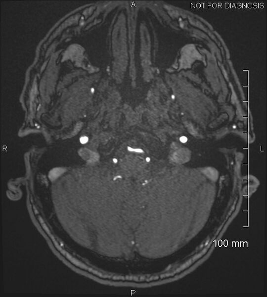 File:Anterior cerebral artery aneurysm (Radiopaedia 80683-94127 Axial MRA 34).jpg