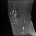 Anterior cruciate ligament tear, Wrisberg rip and bucket-handle tear of medial meniscus (Radiopaedia 75872-87266 Sagittal PD fat sat 26).jpg