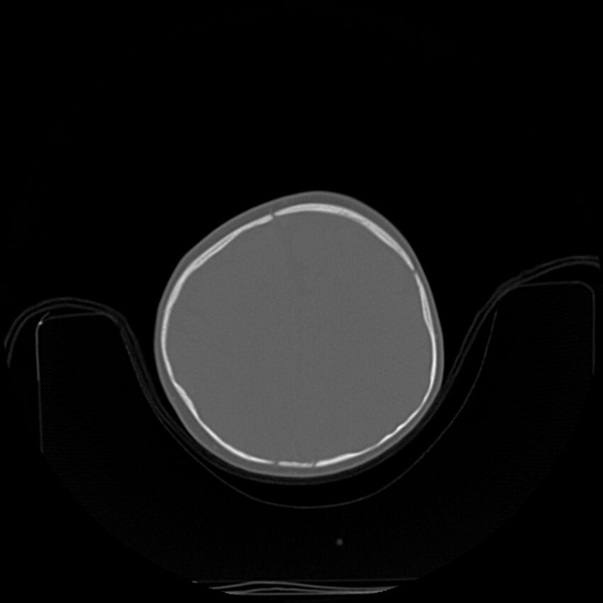 Anterior plagiocephaly (Radiopaedia 71836-82273 C 70).jpg